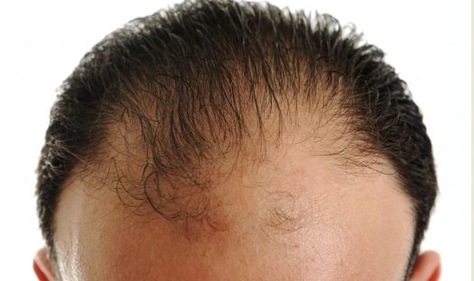 [Image: Signs-of-Receding-Hairline_1.jpg]